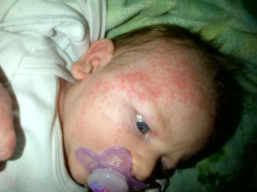 baby eczema BabyCentre