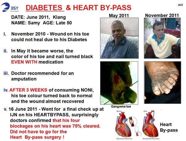 Diabetes and heart pass by BSY Fed Noni