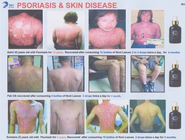 Psoriasis and skin disease BSY Fed Noni