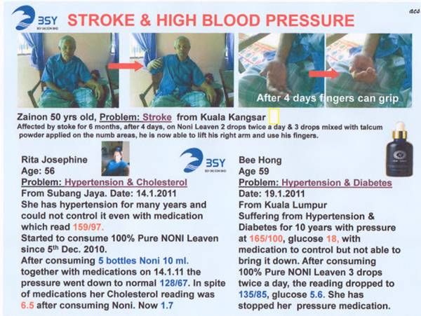 Stroke and HighBlood BSY Fed Noni